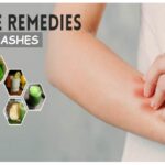 10 Easy Home Remedies for Rashes