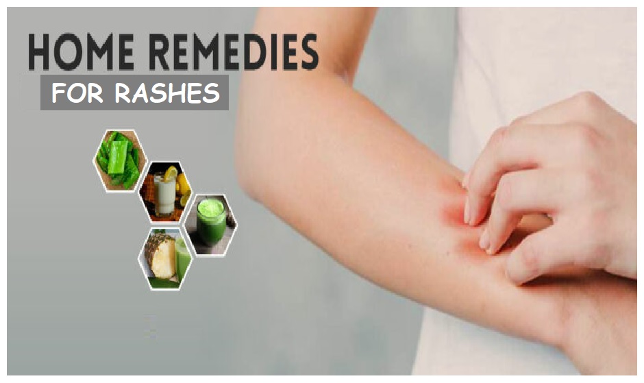 10 Easy Home Remedies for Rashes